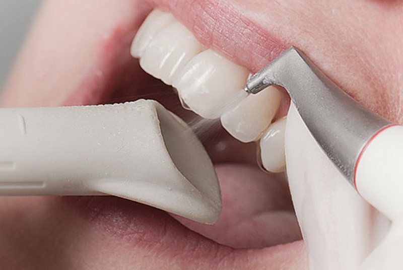 Качественная чистка зубов в Махачкале доступна всем в «Стоматологии 32»